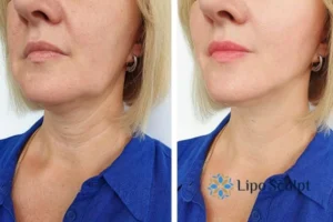 Double chin before and after Hi-Fu treatment 4 Book your double chin treatment Ibstock today! We are here to help!