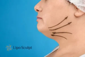 Double chin before and after Hi-Fu treatment 3 Boost your confidence with a Double chin treatment Ibstock