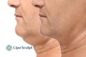 Double chin before and after Hi-Fu treatment 2 Double chin treatment Ibstock from Lipo Sculpt - feel more confident today!