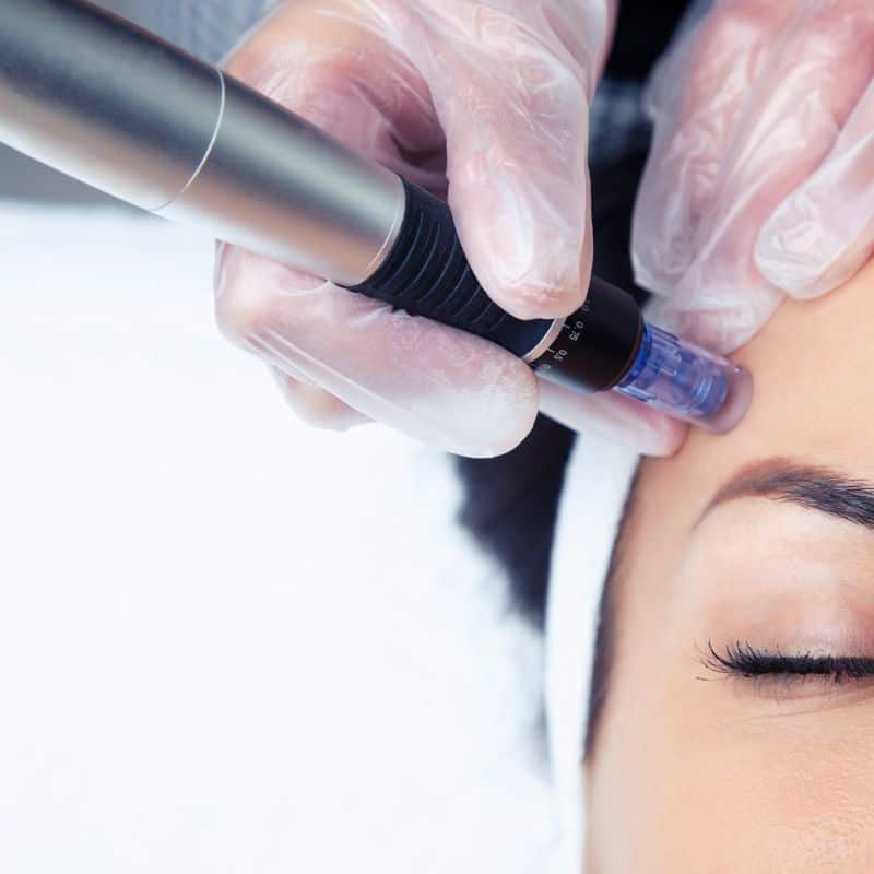 Morpheus8 treatment Ibstock from Lipo Sculpt - Book in today!
